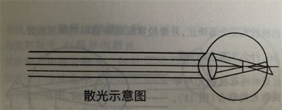 ​散光白内障怎么治疗 散光是白内障的前兆吗
