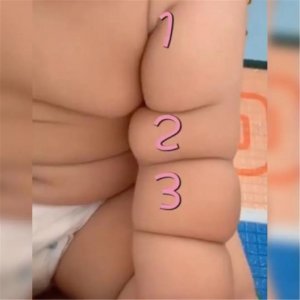 ​“宝宝腿纹不对称”？什么情况？需要看医生吗？