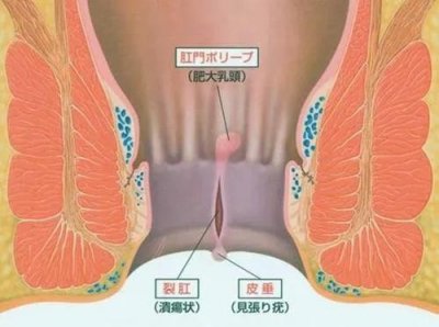 ​肛裂是个什么病？