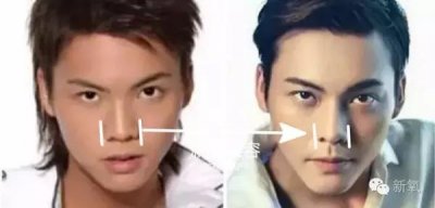 ​陈伟霆整容，蒜头鼻照片