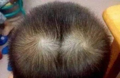 ​孩子头顶“两个旋”，到底代表什么？很多父母不懂，看完涨知识