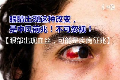 ​眼睛也会中风吗（眼睛中风的解释）