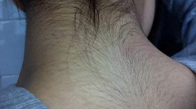 ​女性体毛比较多，说明了什么？体毛旺盛，激素不平衡？医生告诉你